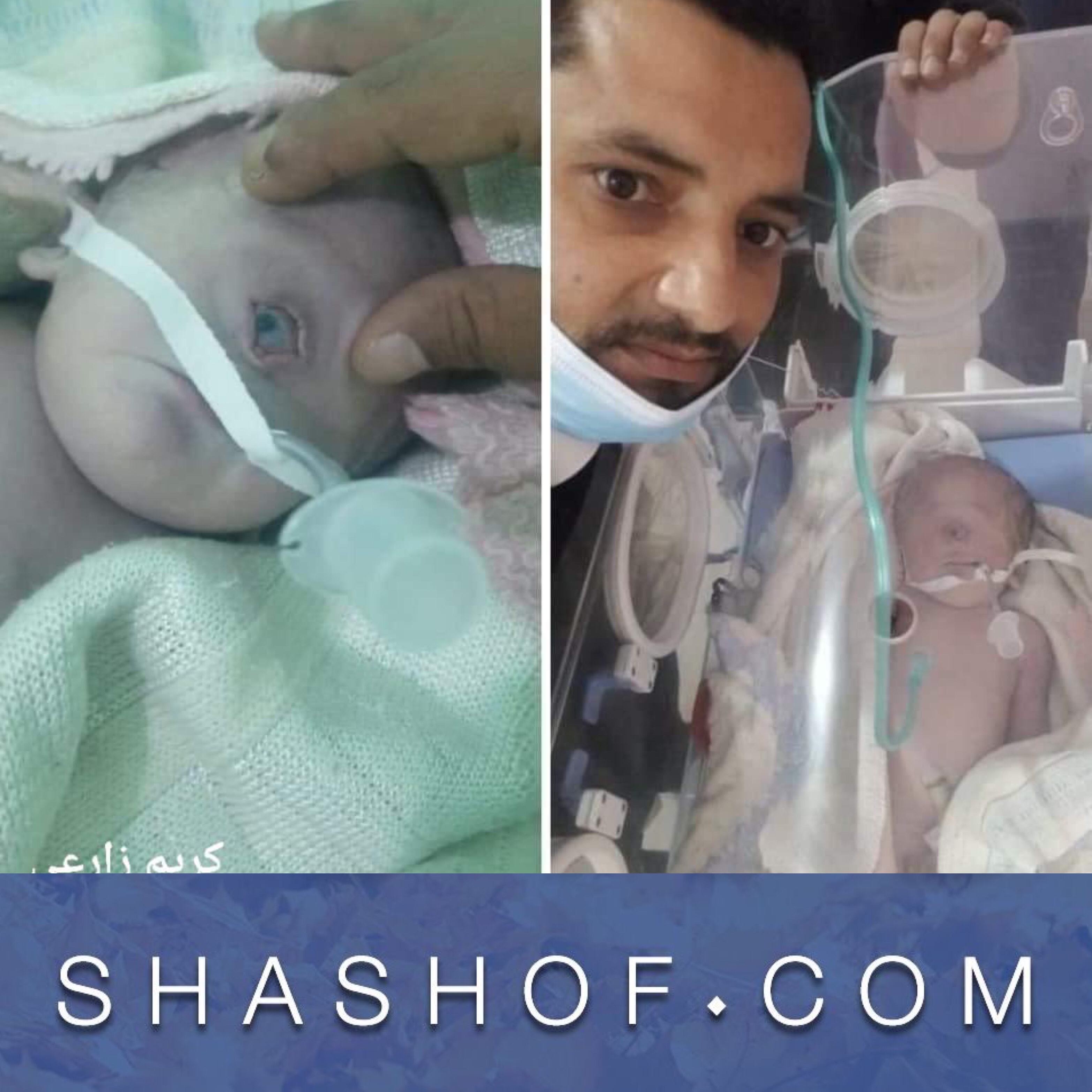 قصة الطفل اليمني الذي ولد بعين واحده في رداع اليمنية “الحقيقة كاملة”