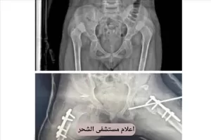 اليمن اليوم اخبار المحافظات – حضرموت .. رغم شحة الإمكانيات نجاح عميلة نوعية بمستشفى الشحر العام