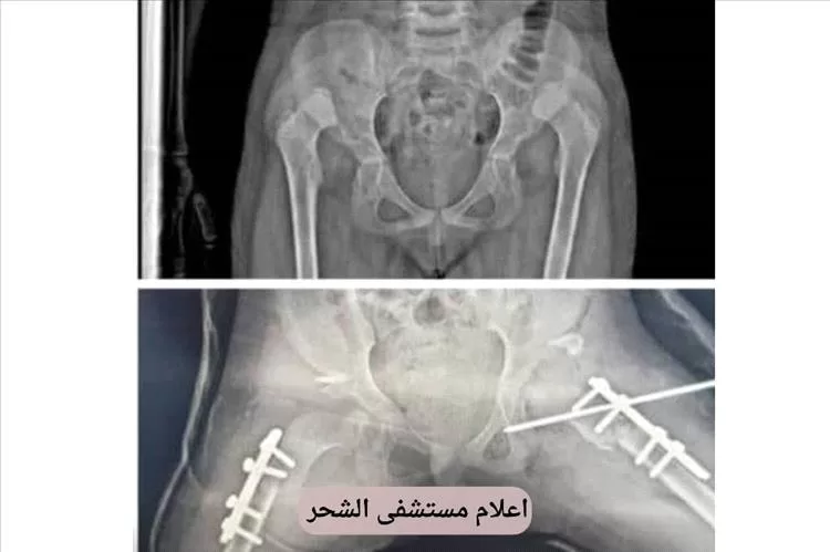 حضرموت .. رغم شحة الإمكانيات نجاح عميلة نوعية بمستشفى الشحر العام