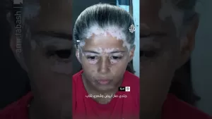 شاهد الطفلة لانا الفلسطينية التي شابت نتيجة الخوف الشديد جراء القصف في غزة